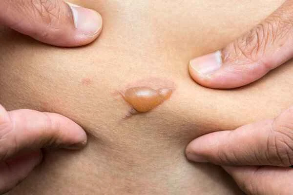 How to determine if a scar is mature?