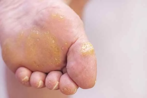 Does plantar wart require treatment?