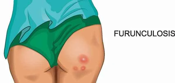 How to prevent itching of keloid scars