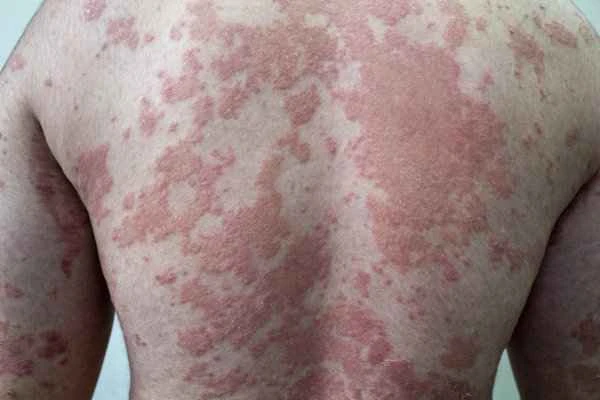 What is pityriasis versicolor?