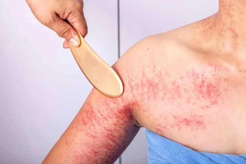 What medicine can help hives heal faster?