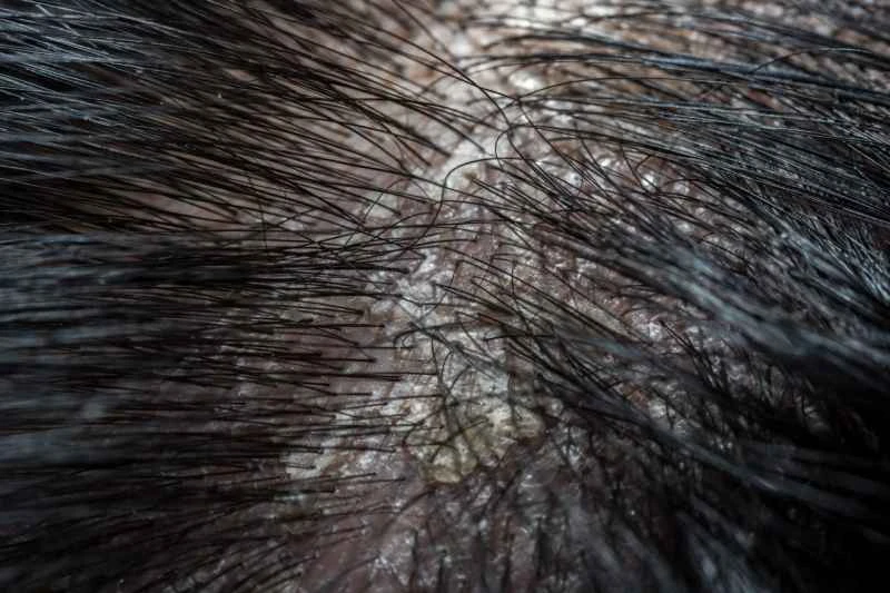 What to do if scalp psoriasis is particularly severe?