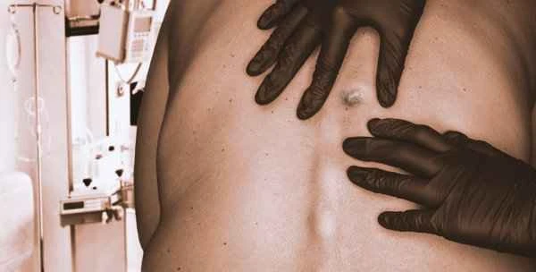 How to remove keloid scars on the chest