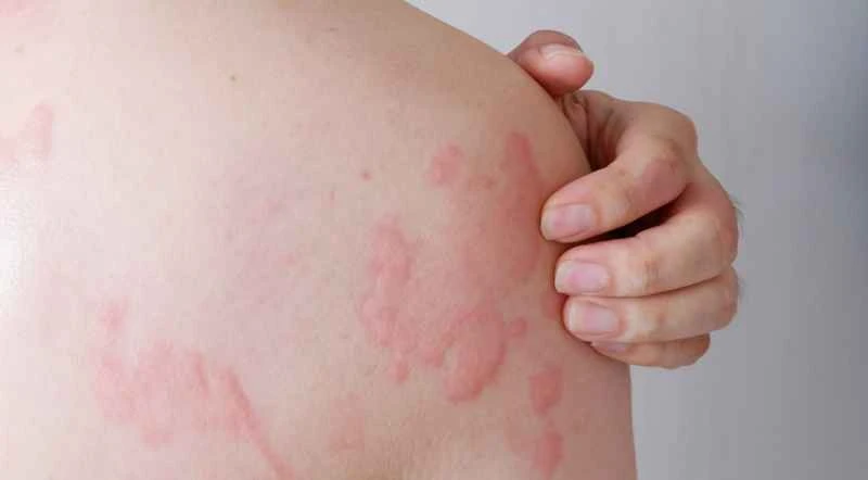 Can acute urticaria be cured completely?
