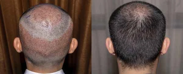 After hair transplantation, the hair follicles swell up, become red, and itch.