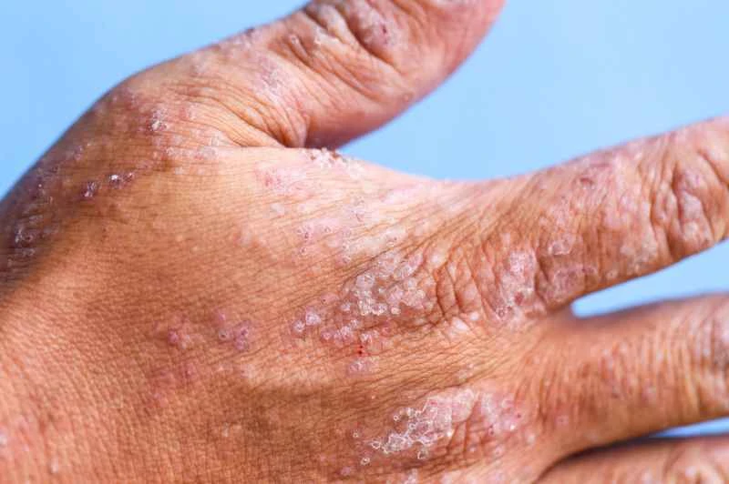 Is generalized eczema contagious?
