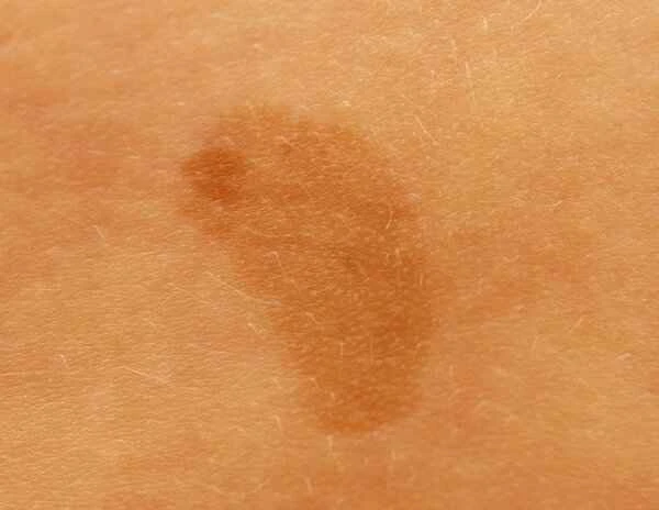 How to tell if someone has a predisposition to keloid scarring