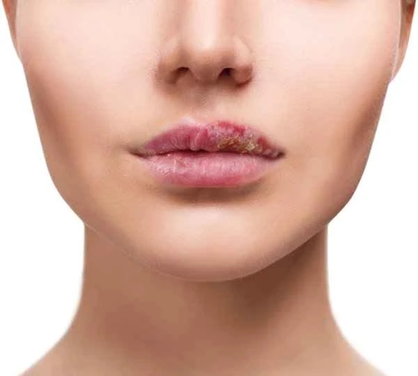 Is dry, cracked, and peeling lips a sign of cheilitis?