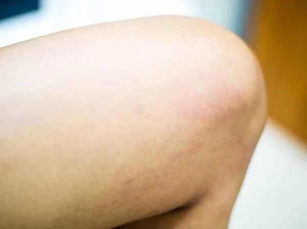 What to eat for chronic allergic urticaria