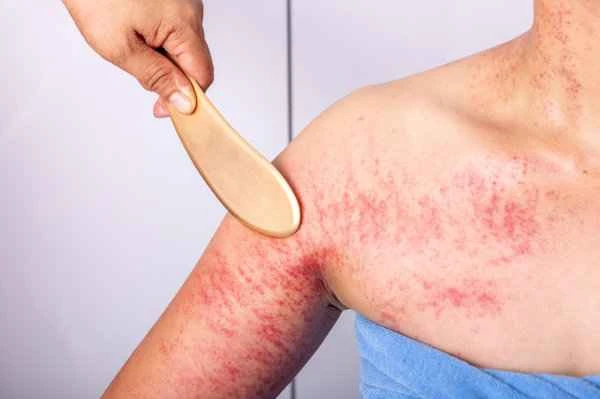 Where can I get treatment for chronic urticaria?