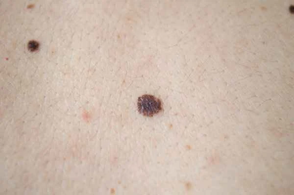 What to do if a melanocytic nevus on the scrotum gets bigger?