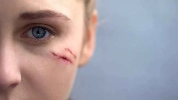 How to cover up forehead scars