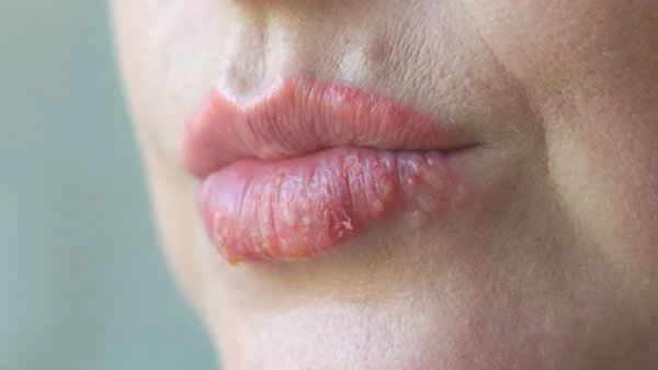 How to remove lip scars
