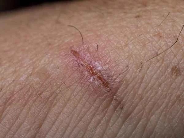 What to do about the pain and itching of scars?