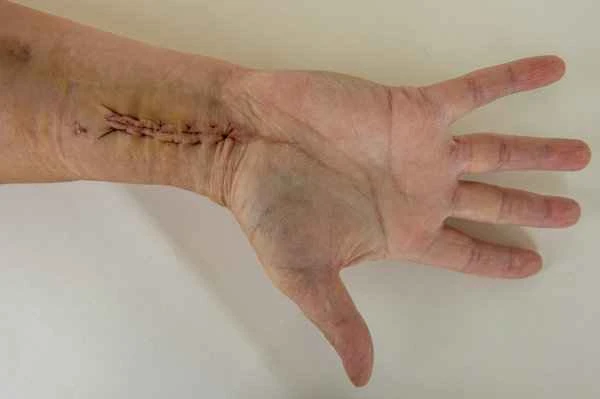 How long does it take for a hard scar on the palm to soften?