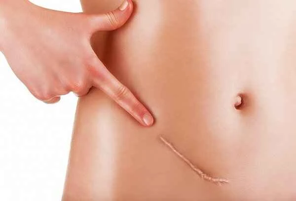 Why is scar tissue white?