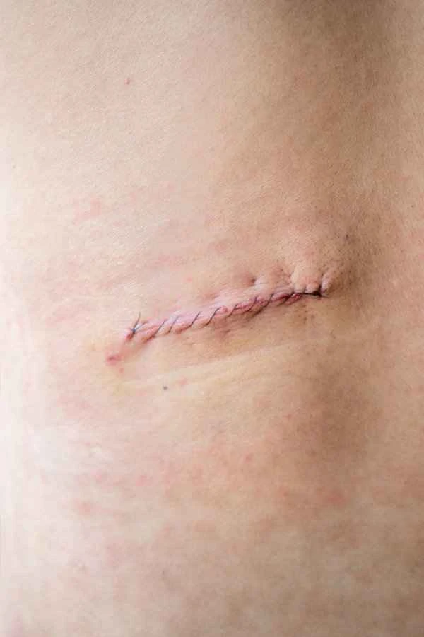 What is a scar fissure?