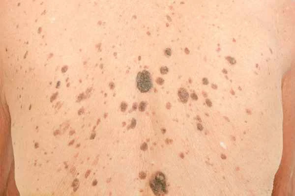 A small black dot on the skin, when squeezed out, produces a long strip.