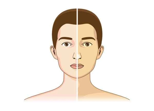 What exactly is vitiligo?