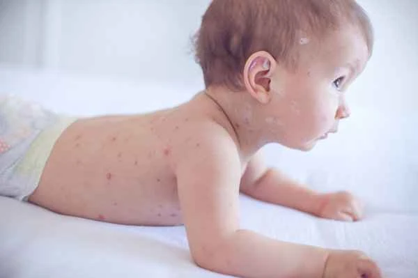 Is recurrent shingles difficult to treat?