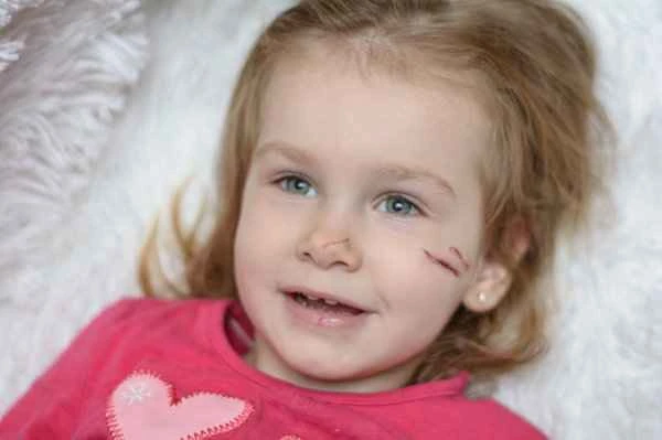 How long does it take for facial avulsion scars to heal?