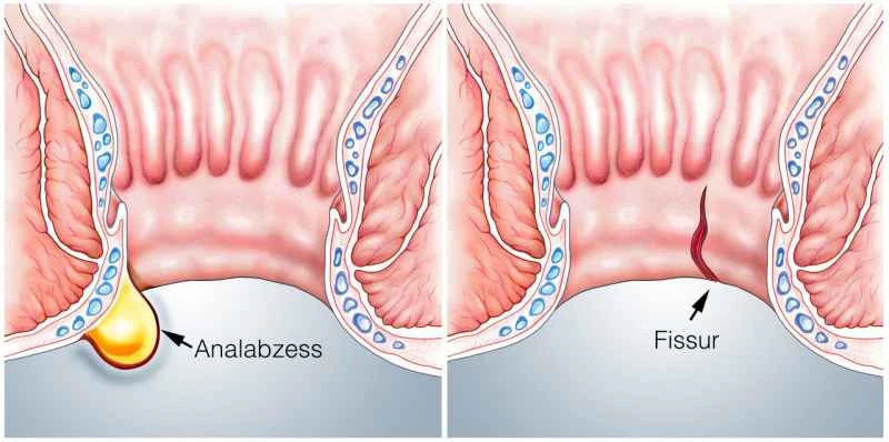 What ointment is most effective for anal eczema in men?