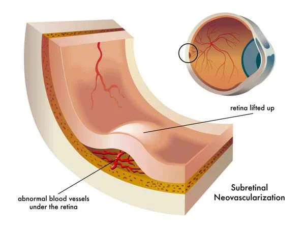 How to treat scar neovascularization effectively?