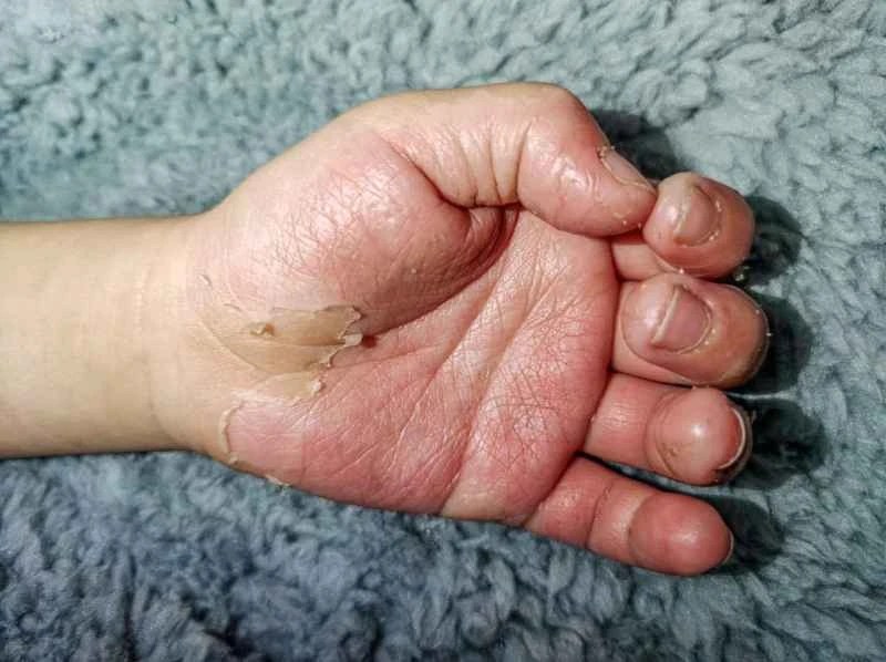 Is eczema in children contagious?
