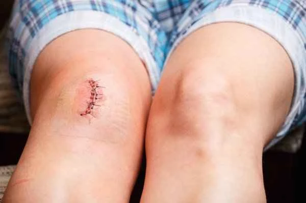 How to define a noticeable scar