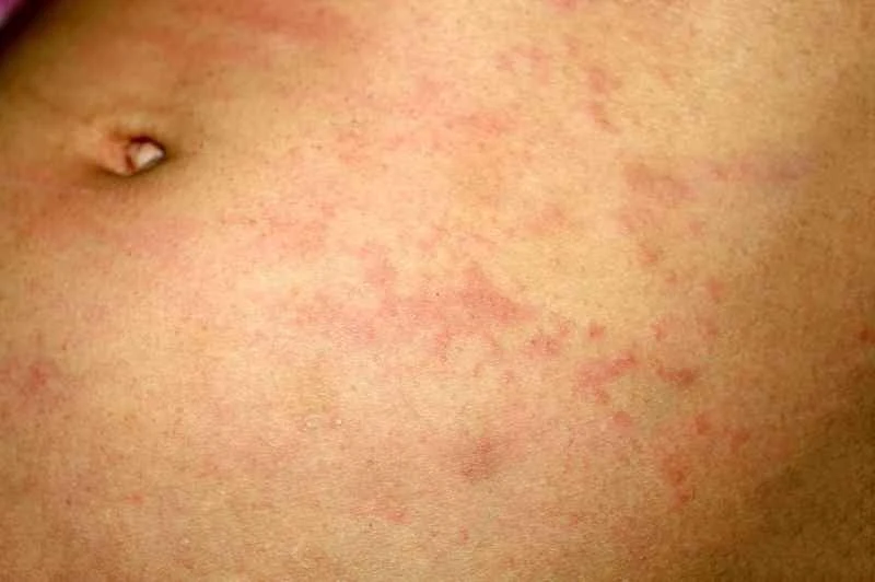 Can acute urticaria be cured completely?