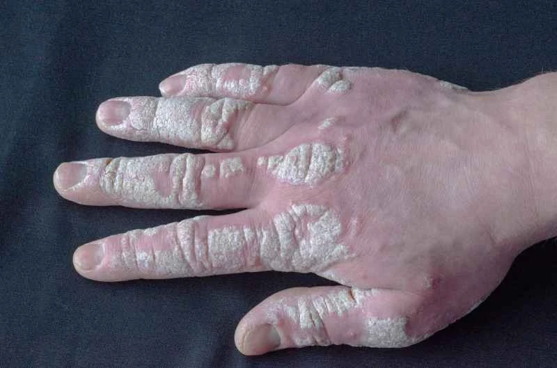 What are the symptoms of psoriatic arthritis?