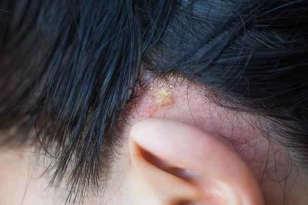 How to treat seborrheic dermatitis of the scalp