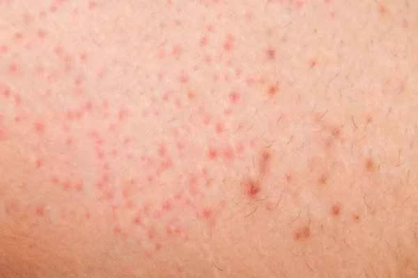 What to do about severe pain from scrotal folliculitis?