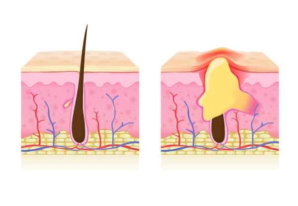 How to tell if someone has a predisposition to keloid scarring