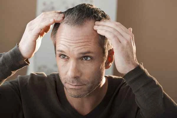 Can severe hair loss on the top of the head be reversed?