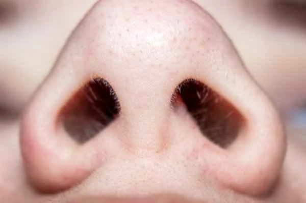 How to remove hypertrophic scars on the tip of the nose?