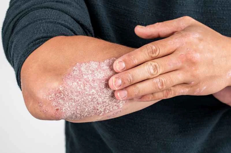 Causes of pustular psoriasis