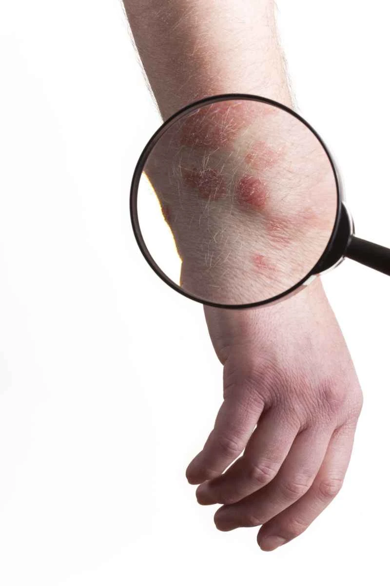 What causes psoriasis and how is it treated?