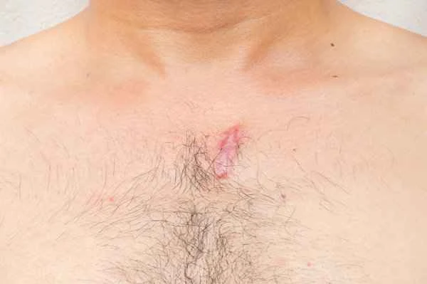 What to do about postoperative scars