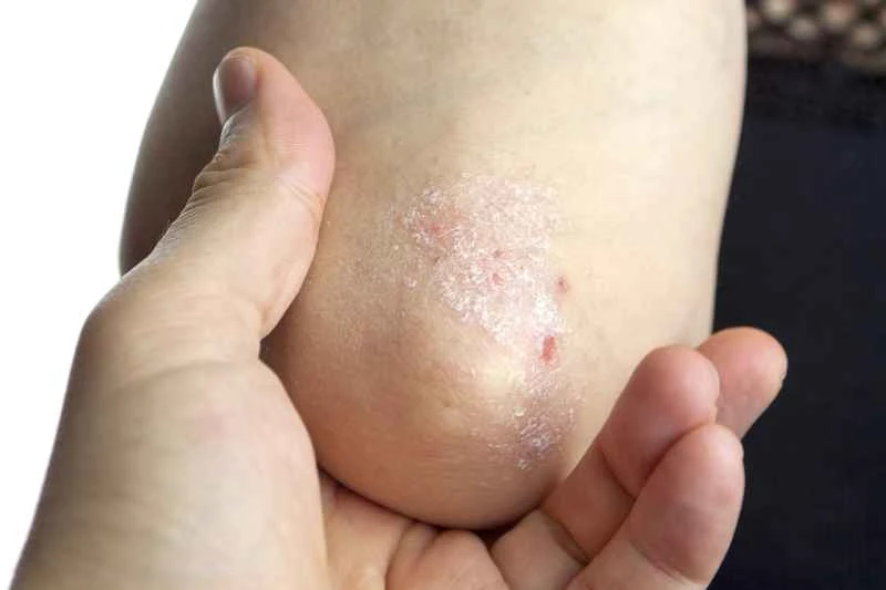 How to cure psoriasis completely? What injections are needed?