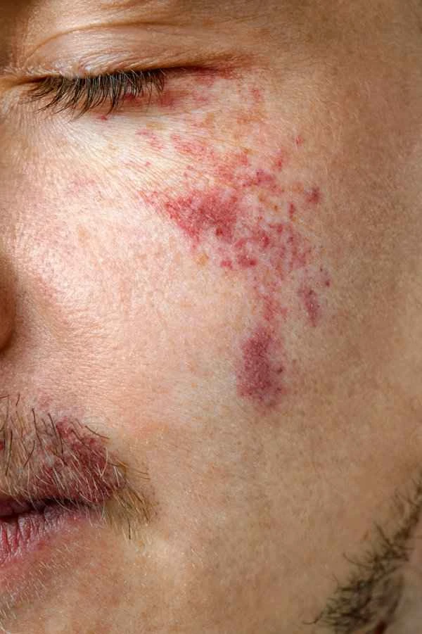 Symptoms of reverse psoriasis