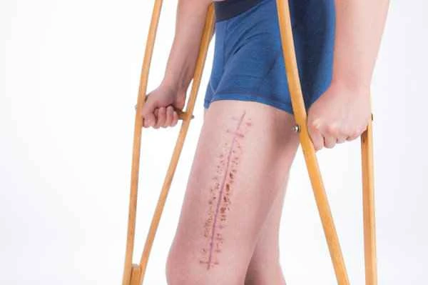 How to remove scars after ACL surgery