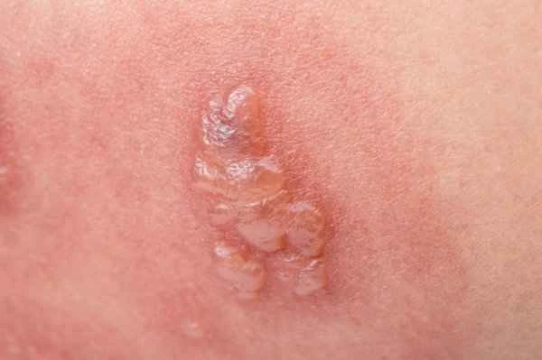 How to treat large keloid scars effectively?