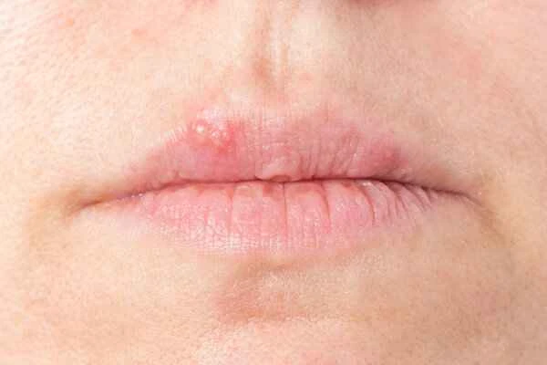 How to remove linear scars on the lips