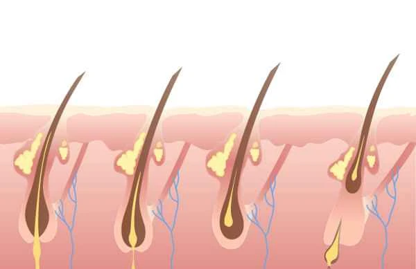 How to prevent hair growth on scars?
