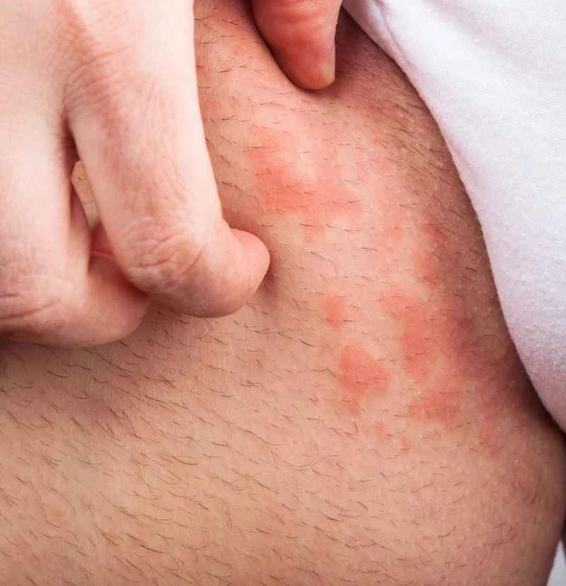 Causes and symptoms of eczema