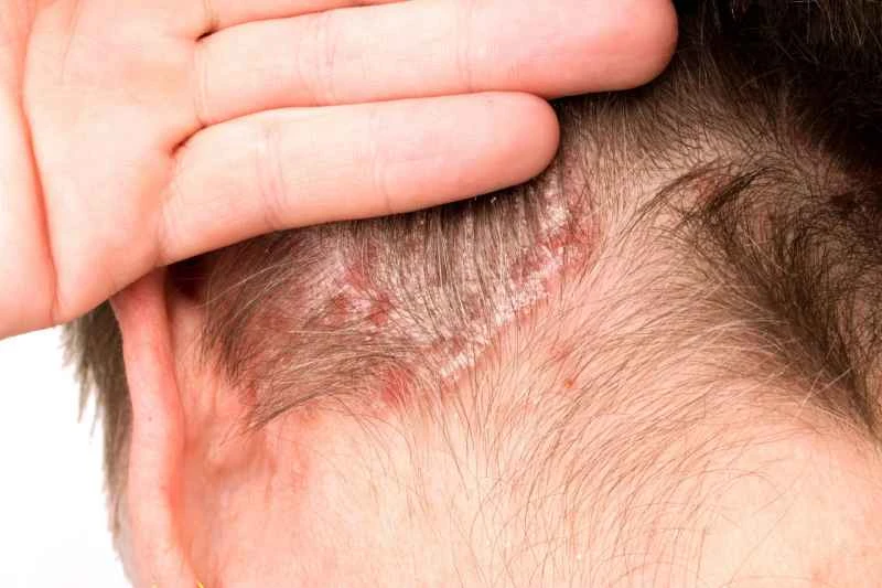 Can psoriasis be transmitted to a partner?