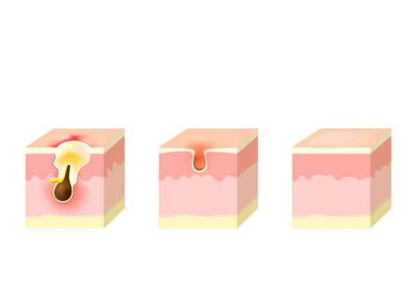 Will keloid scars get bigger after treatment?