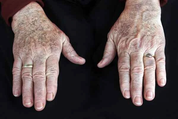 How to diagnose and treat vitiligo effectively?