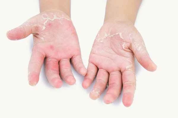 How to completely cure chronic eczema on the fingers